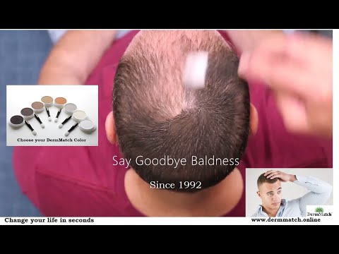 Baldness + Hair loss (Treatment&Solution) - DermMatch #1 - Since 1992